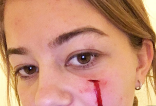 Image shows the scar Sunny left after her attack on the unidentified teen (Twitter)